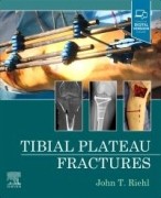 Tibial Plateau Fractures, 1st Edition