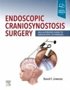 Endoscopic Craniosynostosis Surgery, 1st Edition: An Illustrated Guide to Endoscopic Techniques