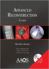 Advanced Reconstruction: Knee 